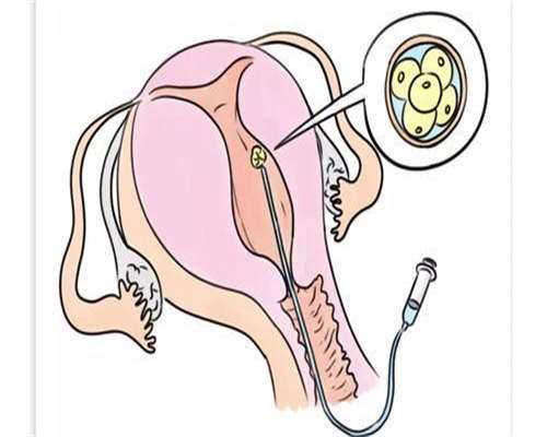 上环的好处和坏处