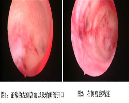 代生男孩技术-怀孕多久可以做药流最好